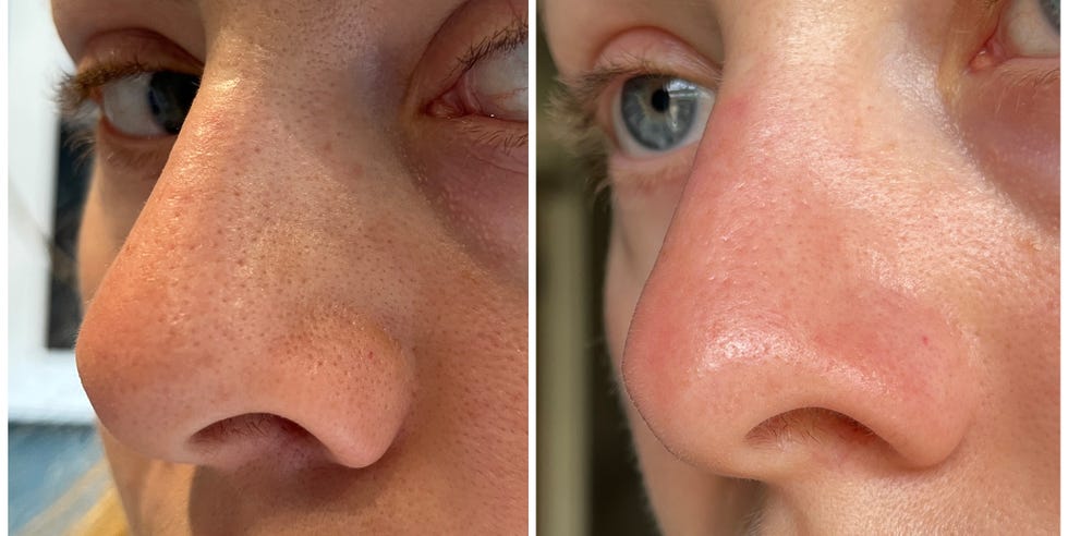 close up of a nose before and after skincare treatment showing reduced pores. shark facialpro glow review. shark facialpro glow before and after