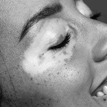 New treatment for vitiligo New treatment for vitiligo