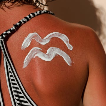 Sunburned shoulder with sunscreen in stripes. Sunburned shoulder with sunscreen in stripes.