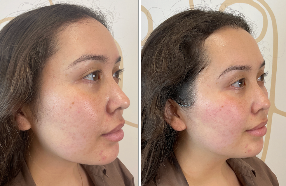 Profile comparison of a person showing skin texture before and after treatment.